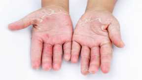 Hand Dermatitis in Two Thirds of Public Due to Frequent Hand Washing During COVID-19