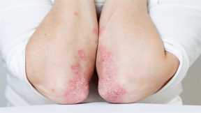High Risk of Bias in Studies of COVID-19 in Patients With Psoriasis and Psoriatic Arthritis