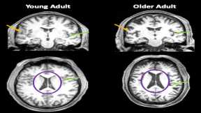 Even Mild Cases of COVID-19 Leave a Mark on the Brain – And It’s Not Yet Clear How Long It Lasts