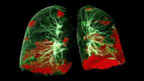 Lung Autopsies of COVID-19 Patients Reveal How Virus Spreads and Damages Tissue, Treatment Clues