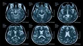 Study Reveals Wide Spectrum of COVID-19 Brain Complications – Including Stroke, Hemorrhage, and Other Fatal Complications
